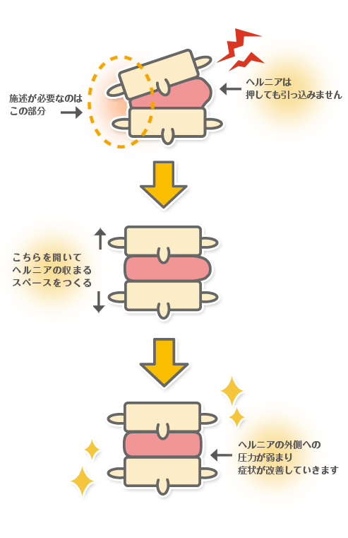 ヘルニアのイラスト