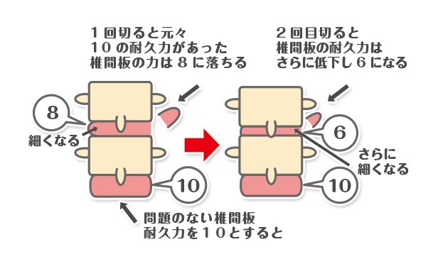 頚椎ヘルニアイラスト