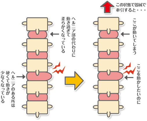 頚椎ヘルニアイラスト