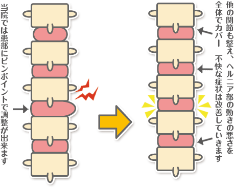 頚椎ヘルニアイラスト