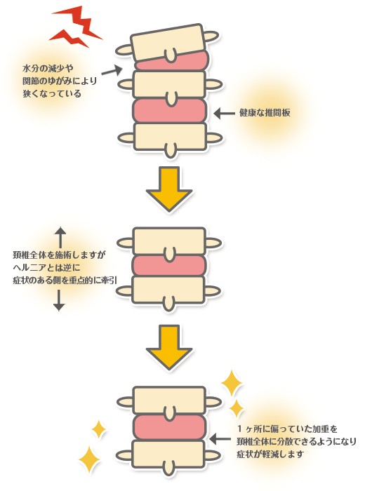 頚椎ヘルニアイラスト