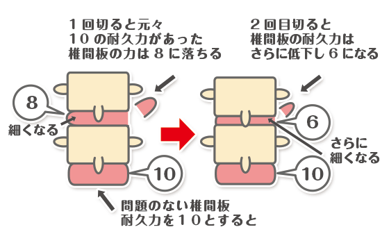 手術をしたヘルニアの説明